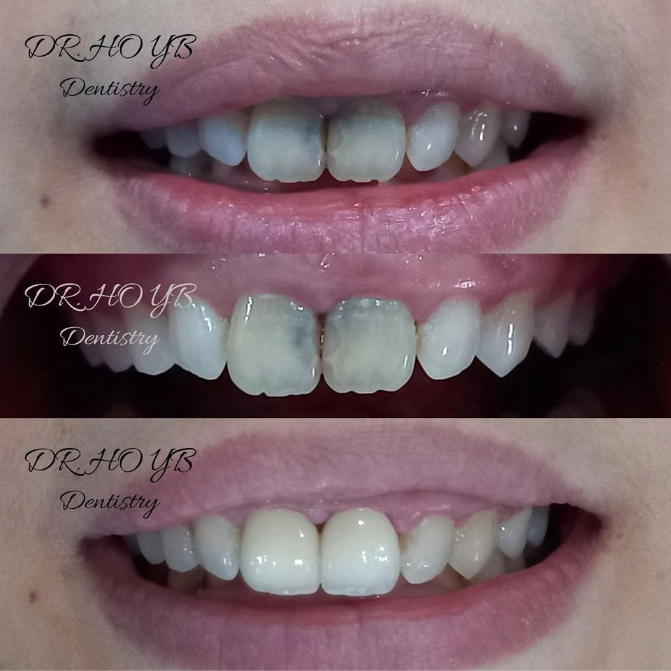 氧化锆牙冠 ZIRCONIA CROWN
